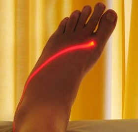 laserowe leczenie żylaków na nogach