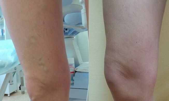 noga przed i po leczeniu żylaków siatkowatych