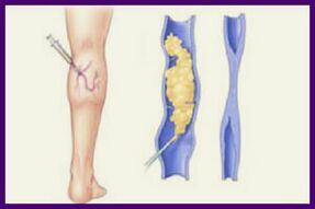Skleroterapia to popularna metoda pozbycia się żylaków na nogach
