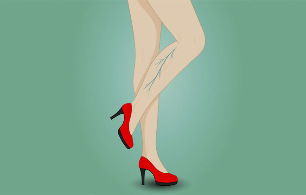 Żylaki na nogach kobiety